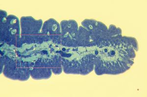 M,60y. | jejunum - amyloidosis(semithin section) M,60y. | jejunum - amyloidosis(semithin section)